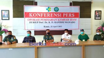 Operasi Pemisahan Bayi Kembar Siam Joana dan Jofelin di Manado Berhasil Dilakukan