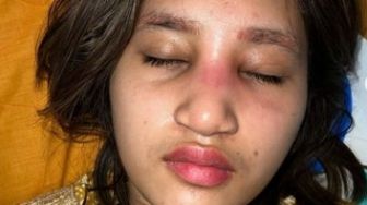 Selebgram Permesta Dhyaz, Anak Youtuber Farida Nurhan Alami Infeksi Implan Hidung, Dokter Tompi Ungkap Penyebabnya