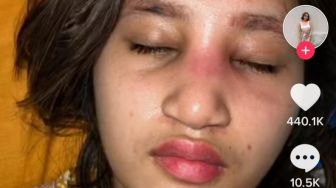 Permesta Dhyaz Alami Infeksi Implan Hidung, Dokter Tompi Ungkap Risiko Bahaya yang Mengintai