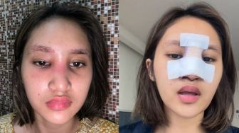 9 Potret Kondisi Terkini Permesta Dhyaz Angkat Implan Hidung, Sempat Heran Ternyata Tak Ada Masalah