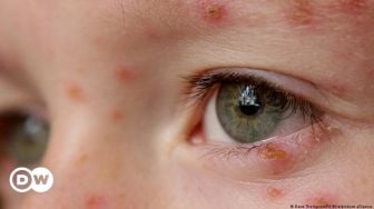 Virus Herpes Terus Mengintai untuk Aktif Kembali dan Menyerang Tubuh