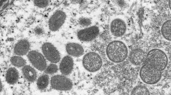 Virus Cacar Monyet Telah Bermutasi Jauh Lebih Cepat, Begini Penjelasan Studi