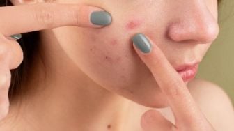 5 Makanan yang Bisa Memperburuk Keadaan Jerawat, Acne Fighters Wajib Tahu!