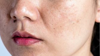 3 Cara Menghilangkan Flek Hitam di Wajah Secara Alami, Terutama di Bagian Hidung