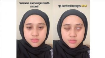 Viral! Gegara Keseringan Kena Kipas Angin, Wajah Perempuan Ini Alami Bells Palsy