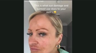 Gegara Sering Berjemur Tanpa Pakai Sunscreen, Wanita Ini Idap Kanker Kulit di Kepala hingga Pitak