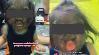 Mengidap Werewolf Syndrome, Tubuh hingga Wajah Bocah Perempuan Ini Ditumbuhi Rambut, Publik: Tetap Cantik