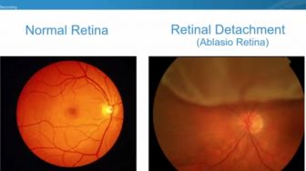 Tanda Awal Ablasio Retina, Dokter Haruskan Periksa jika Mendadak Muncul Bercak Hitam di Mata