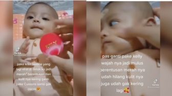 Viral Kulit Bayi yang Beruntusan Dioles Kelly Pearl Cream, Apa Kegunaan Produk Ini?