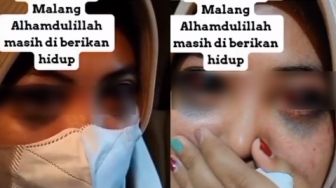 Ngeri! Wanita Ngaku Korban Tragedi Kanjuruhan Mata Rusak Diduga Gegara Gas Air Mata, Polisi Didesak Tanggung Jawab