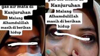 Viral, Video Perempuan dengan Mata Menghitam Dinarasikan Korban Gas Air Mata Kanjuruhan