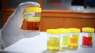 Kenali 6 Warna Urine Normal Sebagai Indikasi Kesehatan Tubuh, Cegah Gagal Ginjal Akut