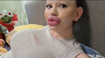 Sudah Diperingatkan Dokter, Wanita Ini Tak Mau Berhenti Suntik Filler Bibir