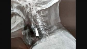Rasakan Sakit Hampir 8 Dekade, Pria Ini Syok Lihat Peluru yang Bersarang di Lehernya