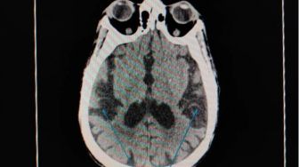 Ketahui Gejala dan Faktor Penyebab Cerebral Atrophy, Terutama pada Anak!