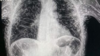 Menkes Budi: Balita Raya Meninggal Bukan karena 1 Kg Cacing, Tapi Sepsis Akibat Infeksi Kronis