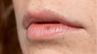 Bibir Kering Bikin Anda Tidak Percaya Diri? Coba Terapkan 6 Tips Berikut