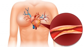 Kadar Kolesterolmu Tinggi? Segera Batasi 4 Jenis Makanan Ini