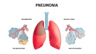 10 Gejala Mycoplasma Pneumoniae, Penyakit Berbahaya Sudah Masuk Indonesia!