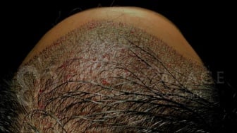 Jakarta Hair Transplant Menggugah Kembali Tren Transplantasi Rambut di Indonesia