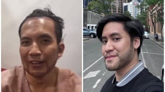 Senasib dengan Kevin Aprilio, Desta Tuai Sindiran Pedas Usai Transplantasi Rambut