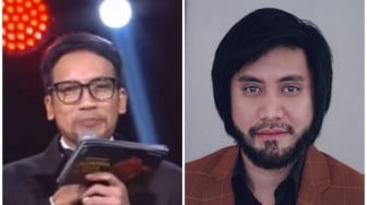 Sentuh 3 Digit, Intip Beda Biaya Transplantasi Rambut Kevin Aprilio dan Desta