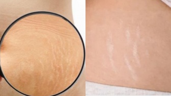 6 Perawatan Efektif Menghilangkan Stretch Mark, Mana Pilihanmu?