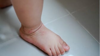Pelayanan RSUD Kayuagung Disorot: Infus Bikin Kaki Bayi Bengkak, Malah Dimarahi