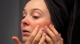 Atasi Wajah Kemerahan Membandel dengan Teknologi VBeam: Lebih dari Sekadar Skincare