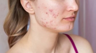 5 Rekomendasi Skincare Penghilang Bopeng di Wajah, Mulai Rp50 Ribuan Kulit Bisa Mulus