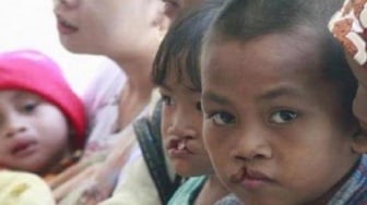 Anak dengan Bibir Sumbing Perlu Operasi dan Terapi Sejak Dini, Ini Penjelasan Dokter