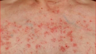 Pertanda di Kulit yang Mesti Diwaspadai Penyebab Leukimia, Diantaranya Kurap