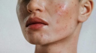 4 Pilihan Sabun Cuci Muka untuk Jerawat, Modal Rp30 Ribuan Wajah Auto Kinclong