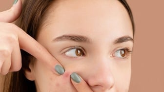 Jerawat Membandel! Ini Solusi Dermatologis yang Aman untuk Kulit Remaja
