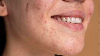 7 Rekomendasi Sunscreen untuk Menghilangkan Bekas Jerawat, Ampuh dan Tidak Lengket