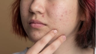 10 Rekomendasi Moisturizer dengan Salicylic Acid, Jerawat Lewat, Wajah Glowing Maksimal