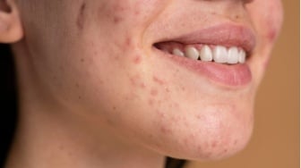 Kenapa Pakai Sunscreen Malah Bruntusan? Ini Penyebab dan 5 Rekomendasi Produk yang Tepat