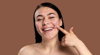 7 Rekomendasi Sunscreen Lokal Fungal Acne Safe, Aman untuk Kulit Terinfeksi Malassezia