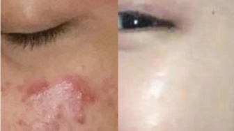 7 Cara Ampuh Atasi Jerawat dengan Produk dan Perawatan yang Tepat, Ini Rekomendasinya!