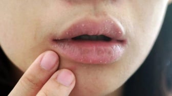 8 Cara Cegah Bibir Pecah-Pecah dan Menghitam, Wajib Tahu Biar Tetap Sehat!