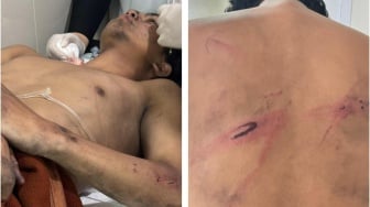 Pulang Rayakan Ultah, Pemuda di Bandung salah Sasaran Polisi hingga Alami Luka Parah