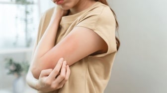 Calamine Powder untuk Apa? Ini 5 Rekomendasi Bedak Pereda Gatal dan Radang Kulit