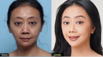 6 Potret Asri Welas Setelah 6 Bulan Oplas: Ini Keputusan Terbaikku!