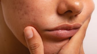 10 Cara Mengatasi Skin Barrier Rusak selain Memakai Produk Skincare