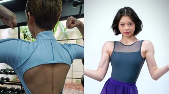 Nada Tarina Pamer Bekas Jahitan Operasi, Kenapa Skoliosis Lebih Rentan pada Wanita?