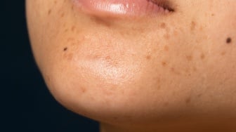 5 Rekomendasi Moisturizer Penghilang Chicken Skin, Kulit Halus Impian Jadi Kenyataan!