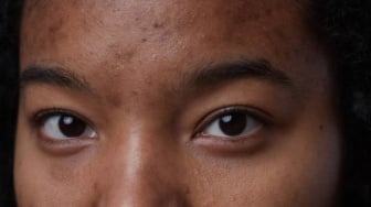 7 Moisturizer untuk Menghilangkan Flek Hitam Bekas Jerawat, Cocok Buat Remaja Hingga Usia 40-an
