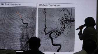Dont Miss a Beat: Setiap Menit Berharga untuk Menyelamatkan Nyawa Pasien Aritmia dan Stroke