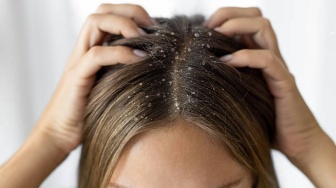 5 Rekomendasi Sampo Terbaik untuk Kulit Kepala Dermatitis Seboroik