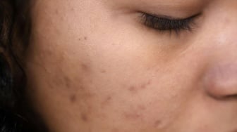 Bekas Jerawat Membandel? Coba 4 Cara Alami Ini, Bahannya Mudah Didapat